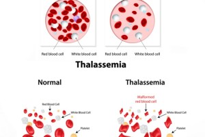 Tips for Living with Thalassemia tips for living with thalassemia