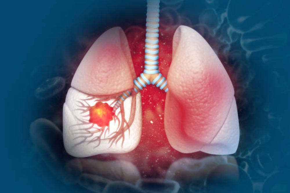 everything you should know about lung cancer