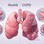 COPD Symptoms, Causes, and Treatment You Should Know