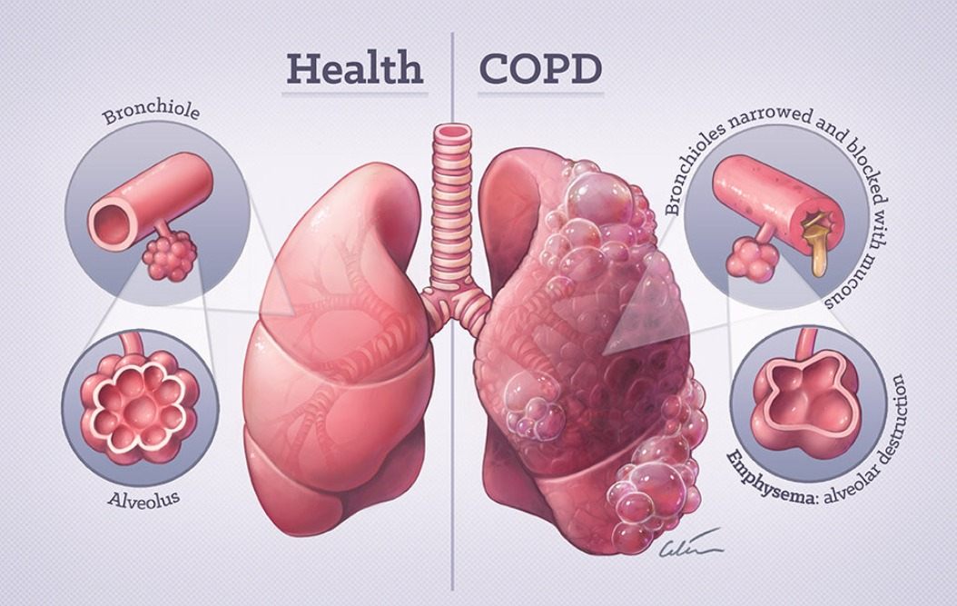 COPD Symptoms, causes, and treatment