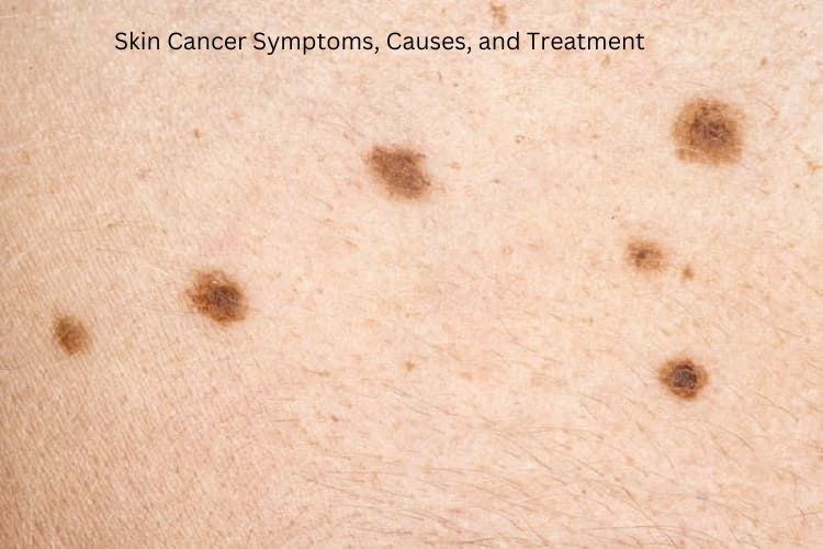 Skin Cancer, Symptoms, Causes, and Treatment
