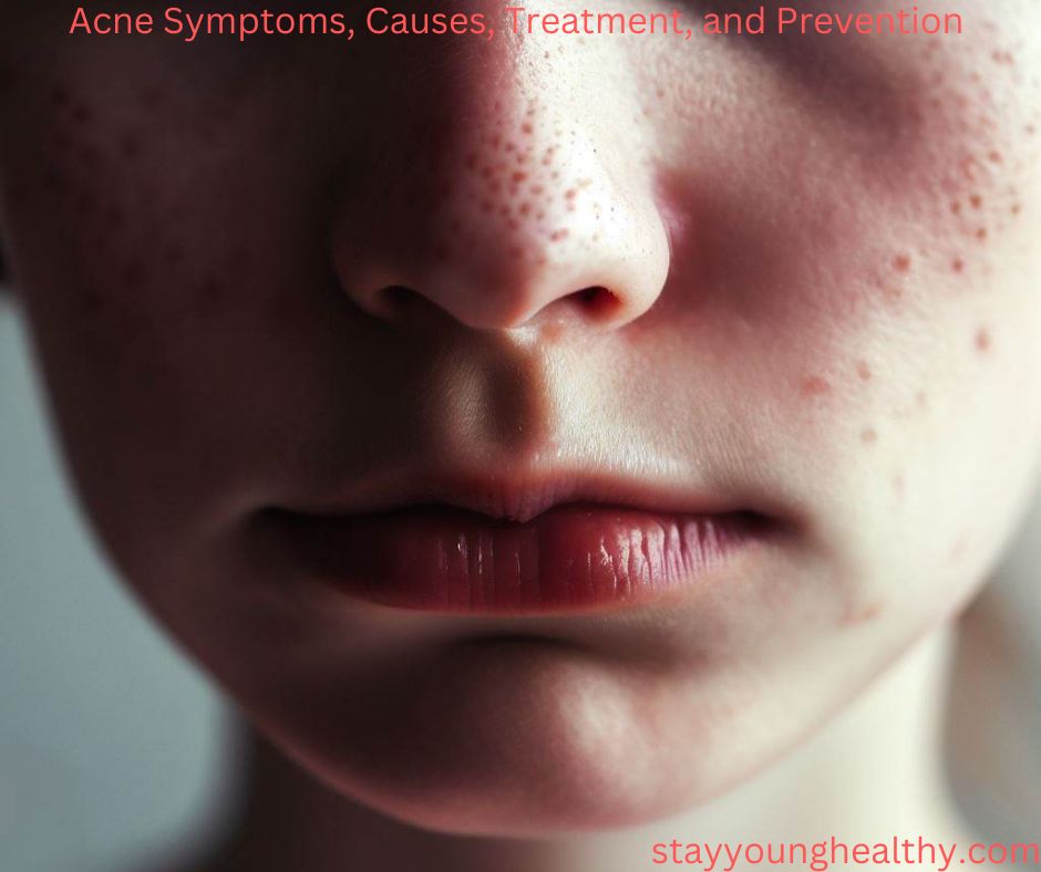 Acne Symptoms Causes Treatment And Prevention