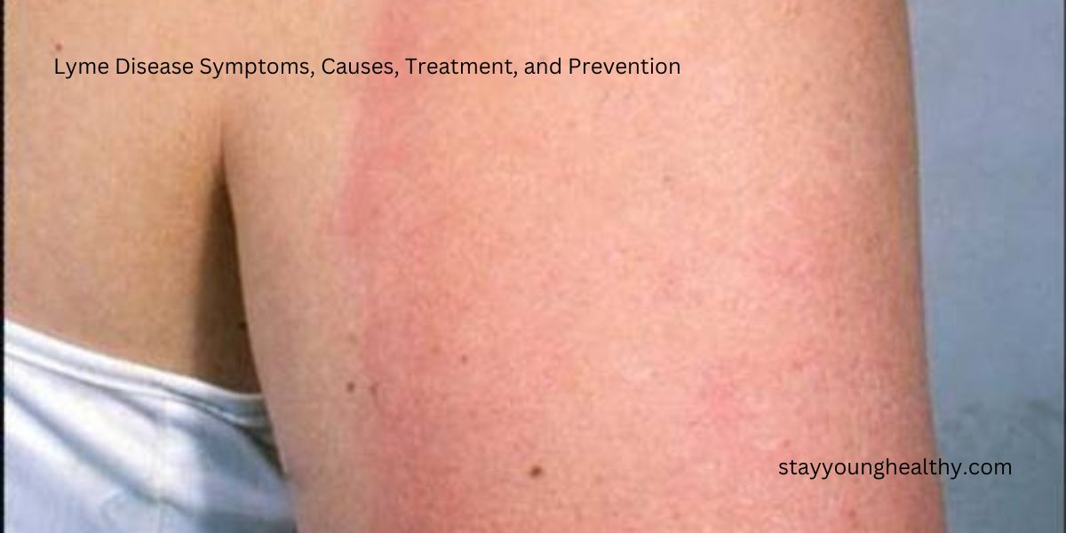 Lyme Disease Symptoms